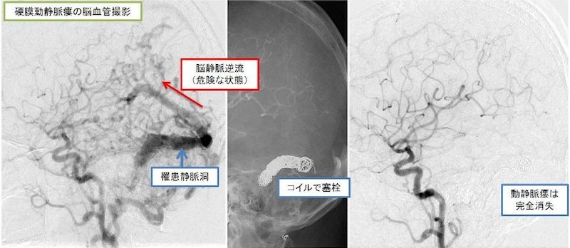 脳神経外科疾患メモ Vol 3 硬膜動静脈瘻 Dural Arteriovenous Fistura Davf 富山大学医学部脳神経外科