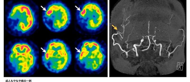 脳神経外科疾患メモ Vol.4 もやもや病と過灌流現象 | 富山大学医学部脳神経外科