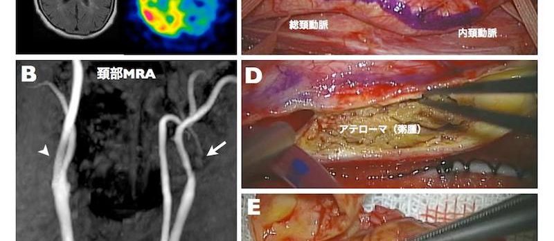 脳神経外科疾患メモ Vol. 10 内頚動脈狭窄症に対する手術 | 富山大学 