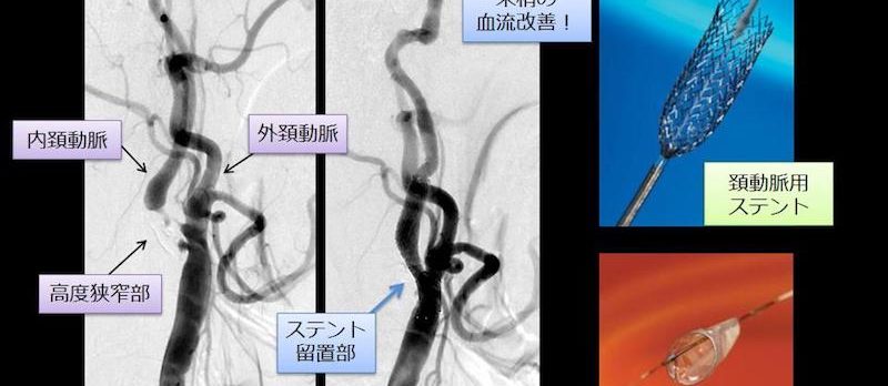 脳神経外科疾患メモ Vol.11 内頚動脈狭窄症に対する血管内治療 | 富山 