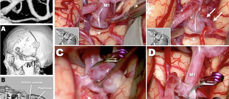 代引き不可 【初版本】中大脳動脈瘤〈ＭＣＡ Ａｎｅｕｒｙｓｍ〉の 